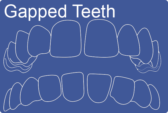 Invisalign can fix Gapped Teeth
